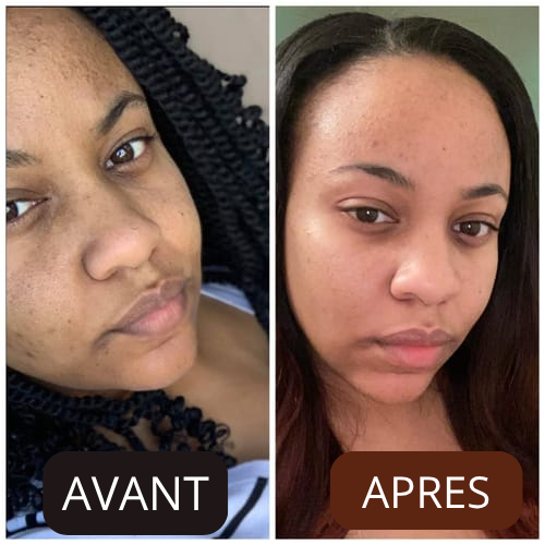 Hyperpigmentation et imperfections