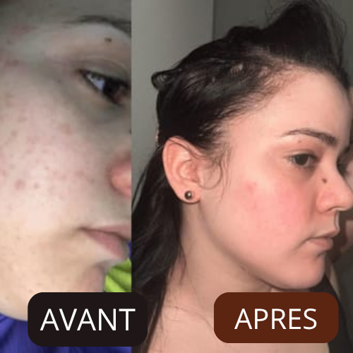 Hyperpigmentation et imperfections