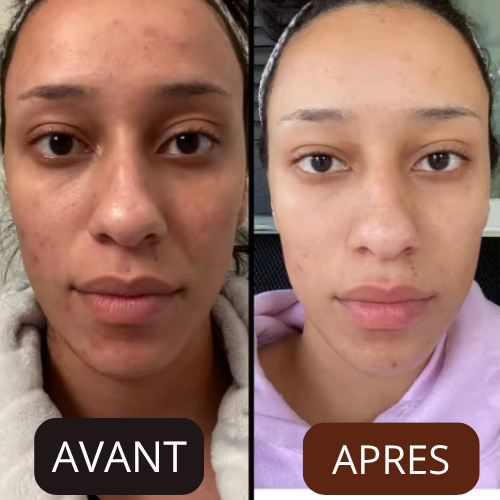 Hyperpigmentation et imperfections